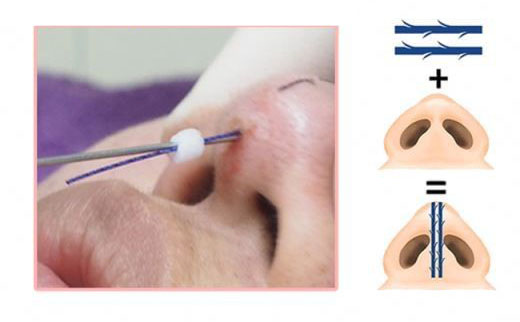 rinoplastika.jpg