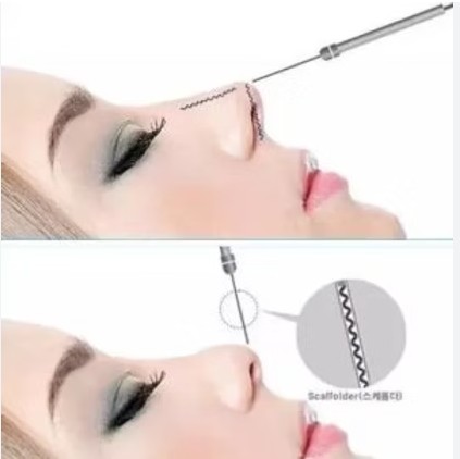 Aestheline ринопластика носа нить R19.jpg