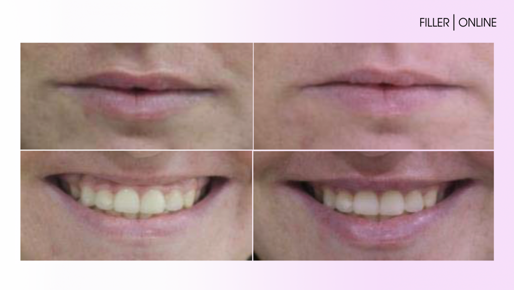 hyaluronic acid_4.png