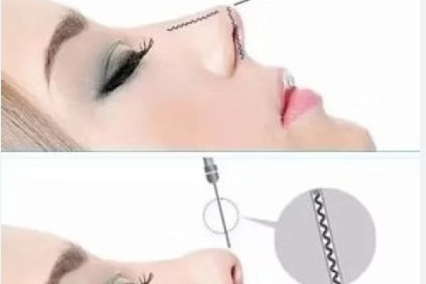 Фото: Безоперационная ринопластика Нитью Aestheline R 19/38 (Эстелайн Ринопластика) какие бывают на рынке Новинки - Описание Сертифицированных Препаратов